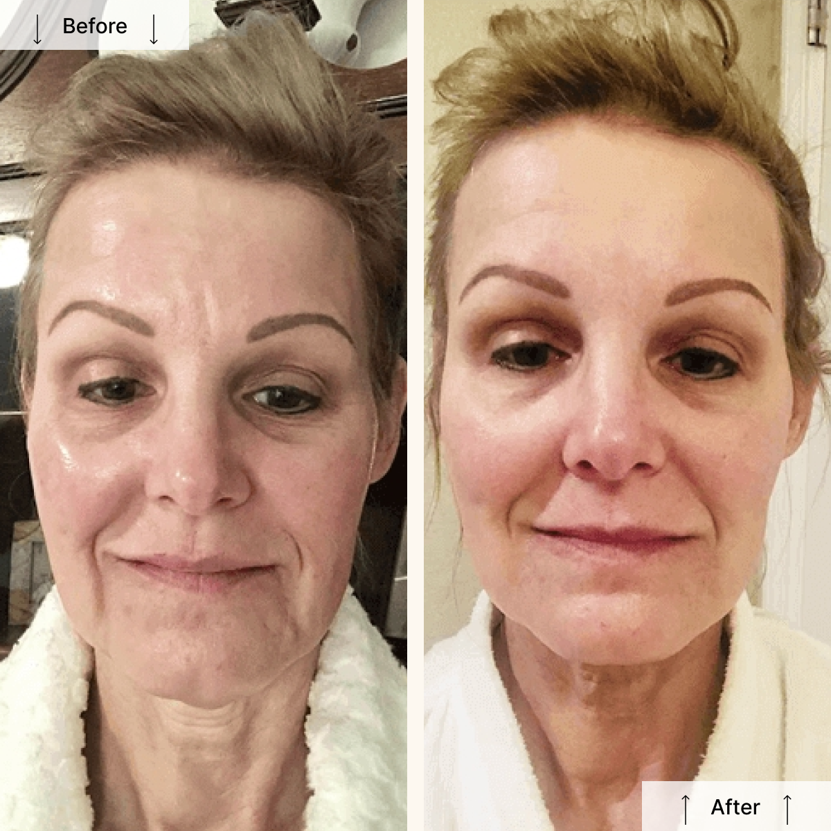 Nuovaluce LED Light Therapy Face Mask