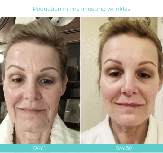 Nuovaluce Anti Aging PRO Microcurrent & Red Light Device Kit with Silver Gel